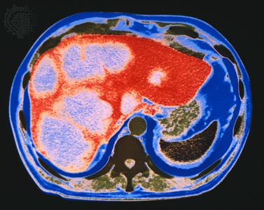 computed tomography (CT) scan of a cross section of the human abdomen, showing cancer of the liver